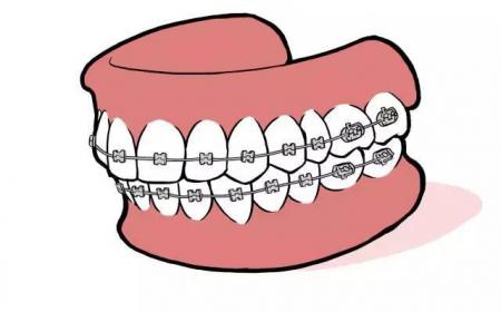 戴牙套怎么清洁牙齿(牙套保持器多久不戴会反弹)