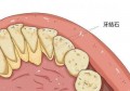 怎么清除牙结石(怎么去除牙结石小妙招)